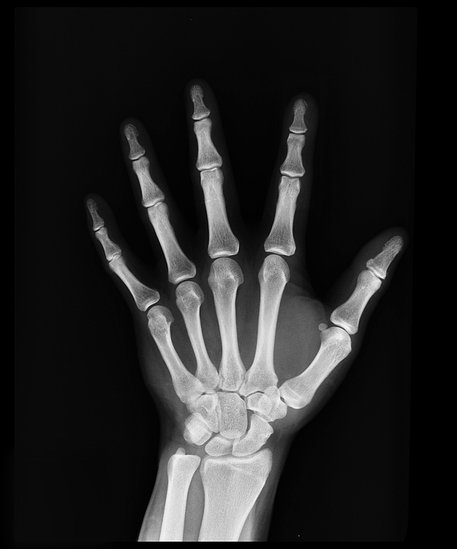 Osteoporosis Prevention