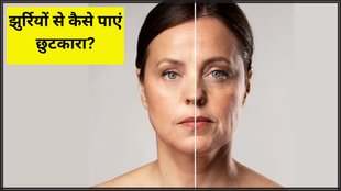 Wrinkles । How to treat Wrinkles । Wrinkles Home remedies