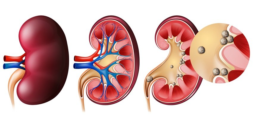 Kidney stone surgery risk