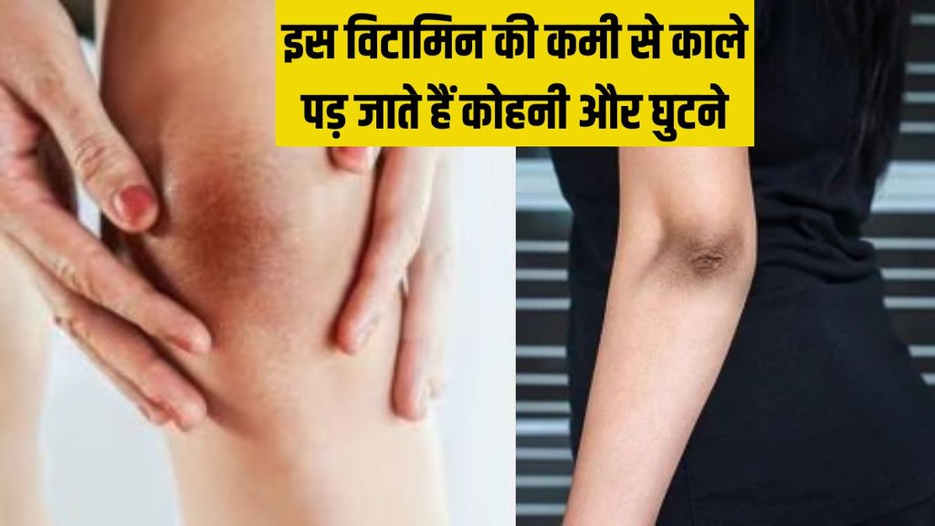 Dark Knees । Dark Elbow । Vitamin B2