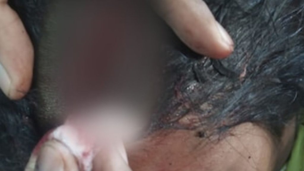 Hapur news, surgical needle inside head