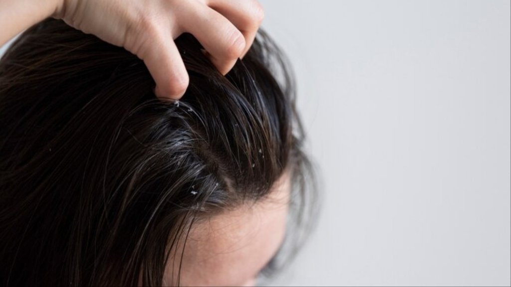 camphor for dandruff, dandruff remedies