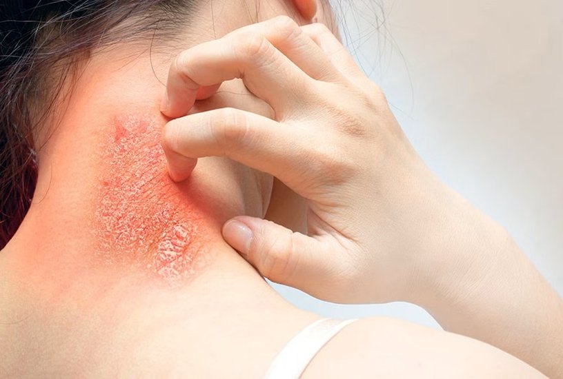 Fungal infections