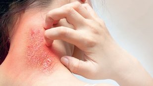 Skin care during monsoon