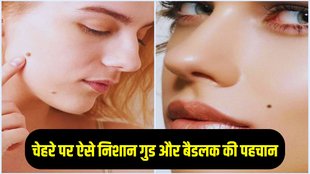 birth mark meaning, birth mark on cheeks, birthmark on face