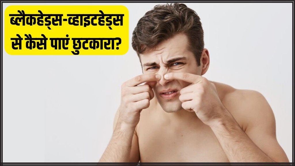 Blackheads । Blackheads remedy । Blackheads on Nose