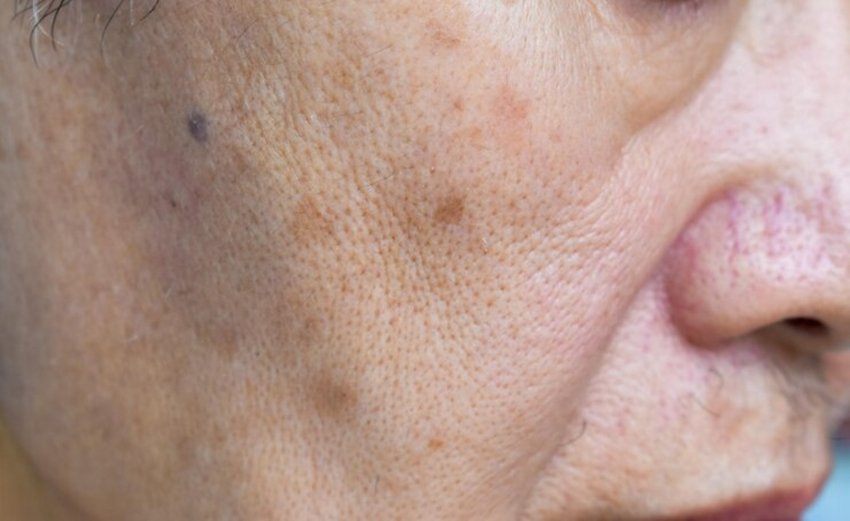 Face pores