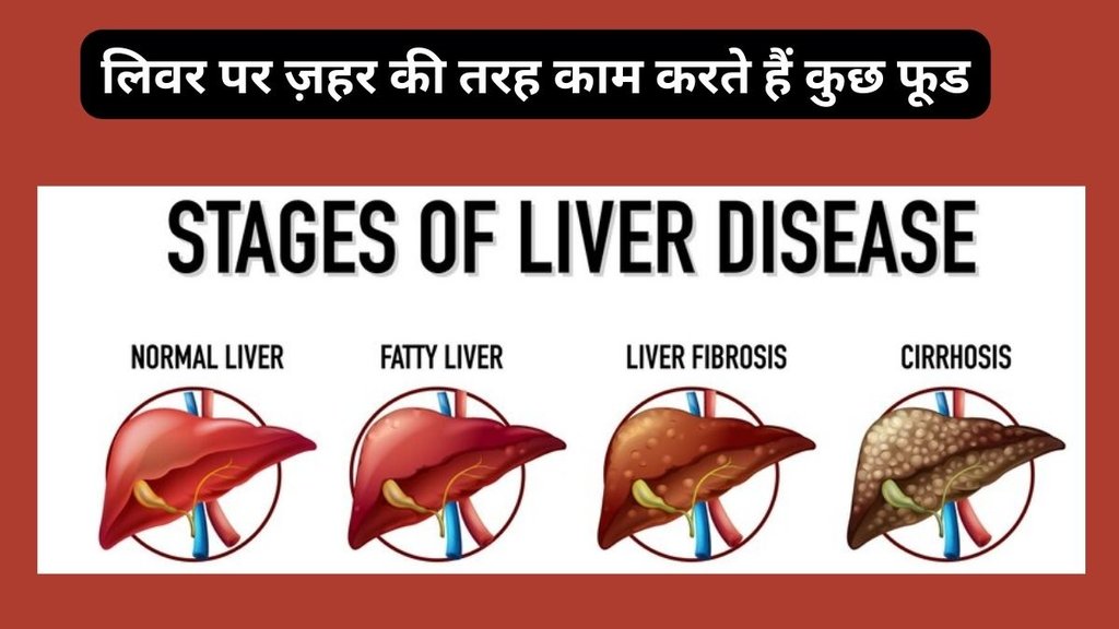 fatty liver cause, fatty liver cure, which foods avoid if you have fatty liver, liver cirrhosis ke lakshan, liver cirrhosis hindi, liver cirrhosis treatment in hindi,