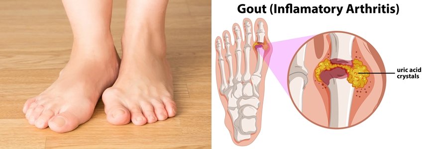gout