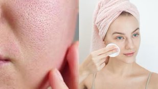open pores why happen