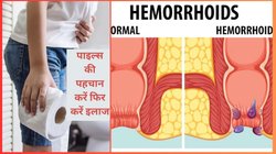 अंदरुनी और बाह्य पाइल्स की पहचान कैसे करें? दोनों में क्या-क्या दिखते हैं लक्षण, एक्सपर्ट से जानिए बचाव का तरीका