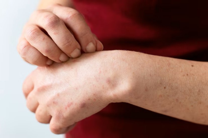 Allergic reactions