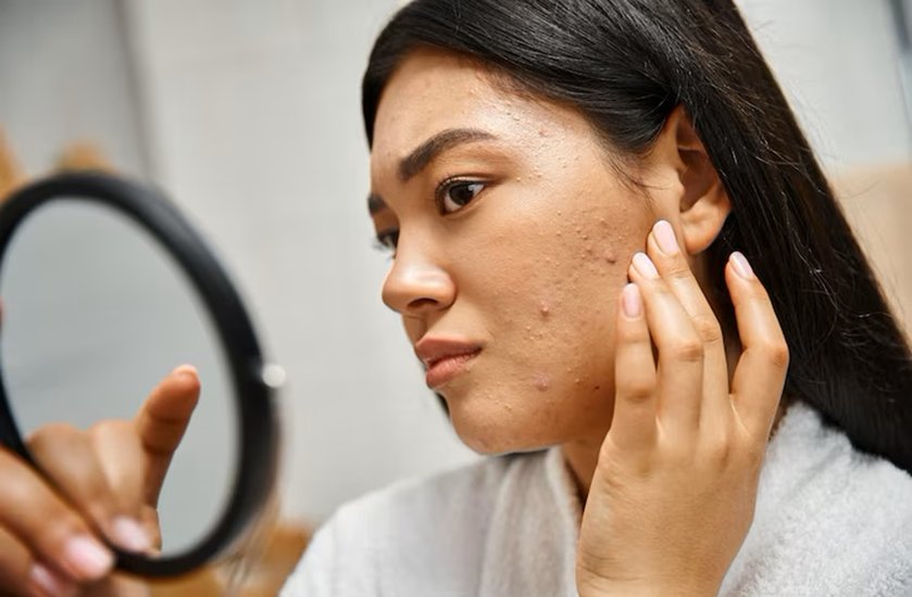 Acne due to Uric Acid