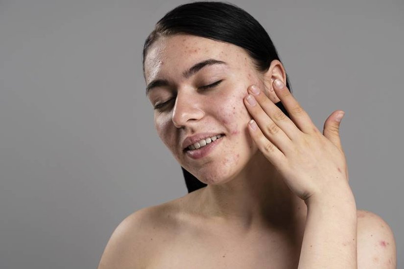 Winters Dry Skin Home Remedy