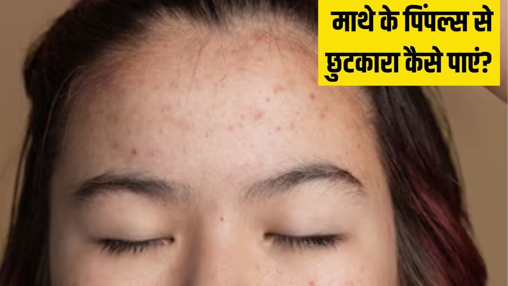 Forehead pimples । How to get rid of Forehead pimples । Forehead pimples Treatment