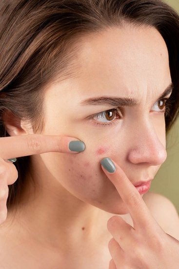 Green tea for acne