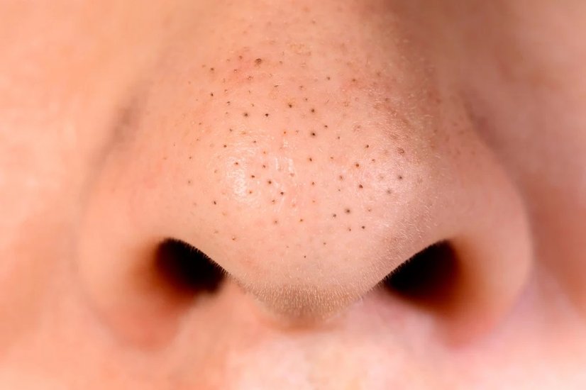 blackheads