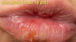 होंठ क्यों फटते हैं? यहां जानें सर्दियों में होने वाली इस आम समस्या का कारण और हल