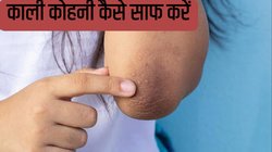 सिर्फ 2 मिनट में दूर करें कोहनी और घुटनों का कालापन, आजमाकर देखें ये देसी चीज