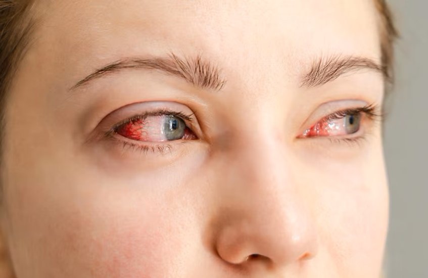 Risks of using fake eyelashes