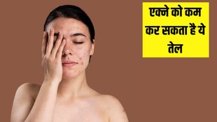 acne Treatment । tea tree oil for acne । Can I apply tea tree oil directly on acne