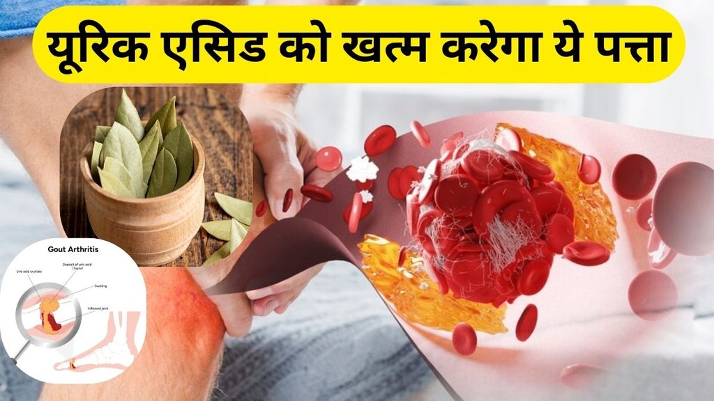 bay leaves control uric acid: यूरिक एसिड को खत्म करेगा ये पत्ता