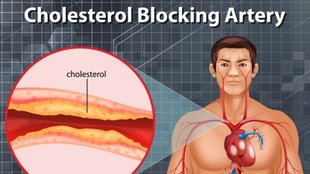 cholesterol control tips: कोलेस्ट्रॉल को कंट्रोल करें
