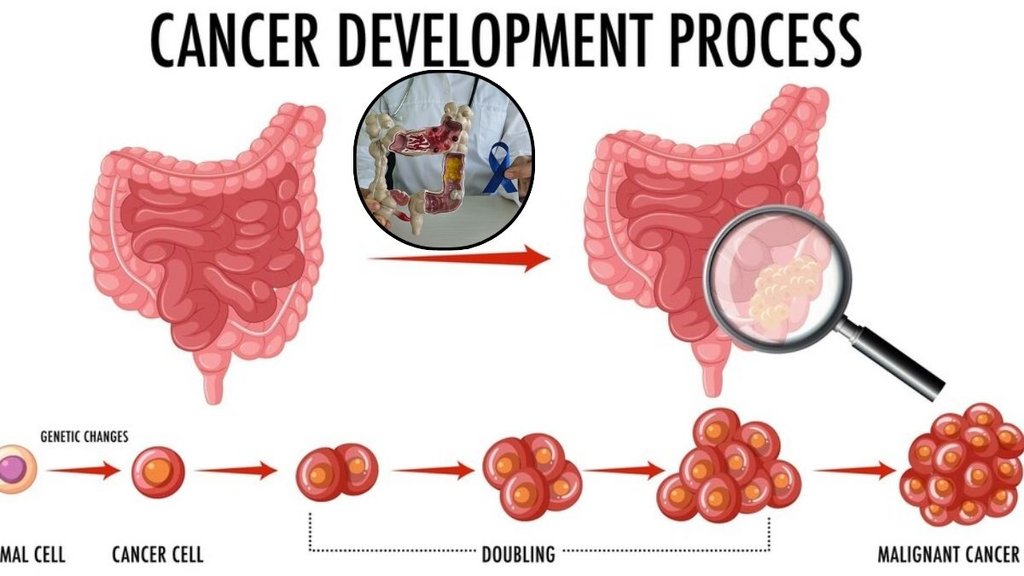 colon cancer: कोलन कैंसर