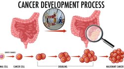 युवाओं में तेजी से बढ़ रहा है Colon Cancer, वजन कम होने के साथ ही पाचन में दिखते हैं ये 10 लक्षण, जानिए कैसे करें पहचान