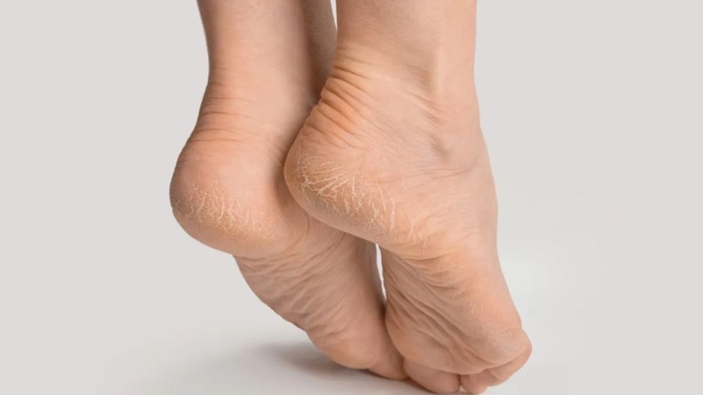 Cracked Heels । Cracked Heels Remedies । winter skin Care । Winter skin Care Tips
