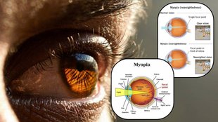myopia causes symptoms and prevention: बच्चों में बढ़ रही मायोपिया