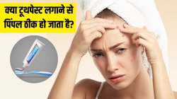 क्या टूथपेस्ट लगाने से पिंपल्स ठीक हो जाते हैं? सेलिब्रिटी डर्मेटोलॉजिस्ट से जानें कितना असरदार है ये नुस्खा