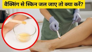 Wax burn । How do you heal a wax burn । Will wax burn leave a scar