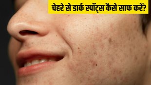Dark spots । How to remove dark spots from face । Dark spots treatment