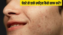 चेहरे से डार्क स्पॉट्स को जल्दी कैसे हटाएं? स्किन के डॉक्टर ने बताए 2 आसान तरीके