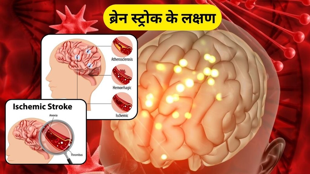 Brain Stroke Symptoms: ब्रेन स्ट्रोक के लक्षण