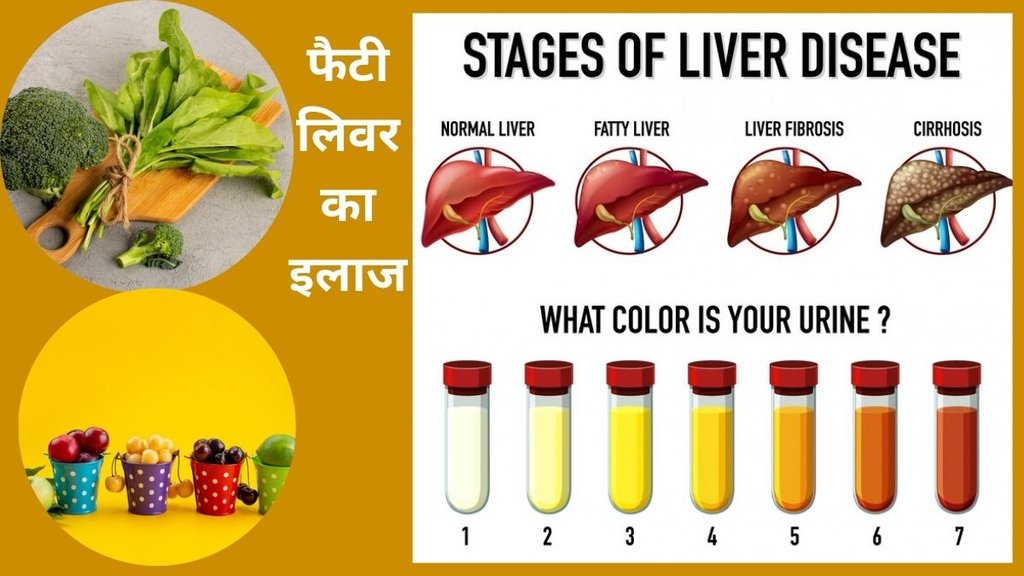 fatty liver test, fatty liver symptoms, fatty liver diet, fatty liver disease, nonalcoholic fatty liver disease, cirrhosis of the liver, liver cirrhosis, cirrhosis of liver, liver cirrhosis treatment, liver cirrhosis symptoms, liver cirrhosis in hindi, liver cirrhosis kya hota hai, liver cirrhosis ke lakshan, liver cirrhosis alcohol,