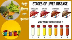 ये 3 टेस्ट बताएंगे कि Liver हो चुका है फैटी, लिवर फैट कंट्रोल करने के लिए खाएं ये 4 सुपर फूड, तुरंत होगा सुधार