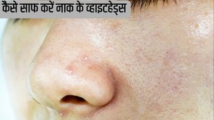 Nose whiteheads removal