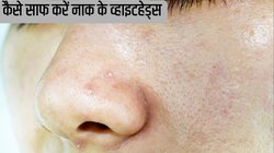 बिना हाथ लगाए कैसे साफ करें नाक के व्हाइटहेड्स, इस्तेमाल करें 3 स्मार्ट ट्रिक्स