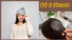 क्या टोपी पहनने से बालों को नुकसान पहुंचता है? जानें सर्दियों में क्यों है ये Scalp infection का कारण