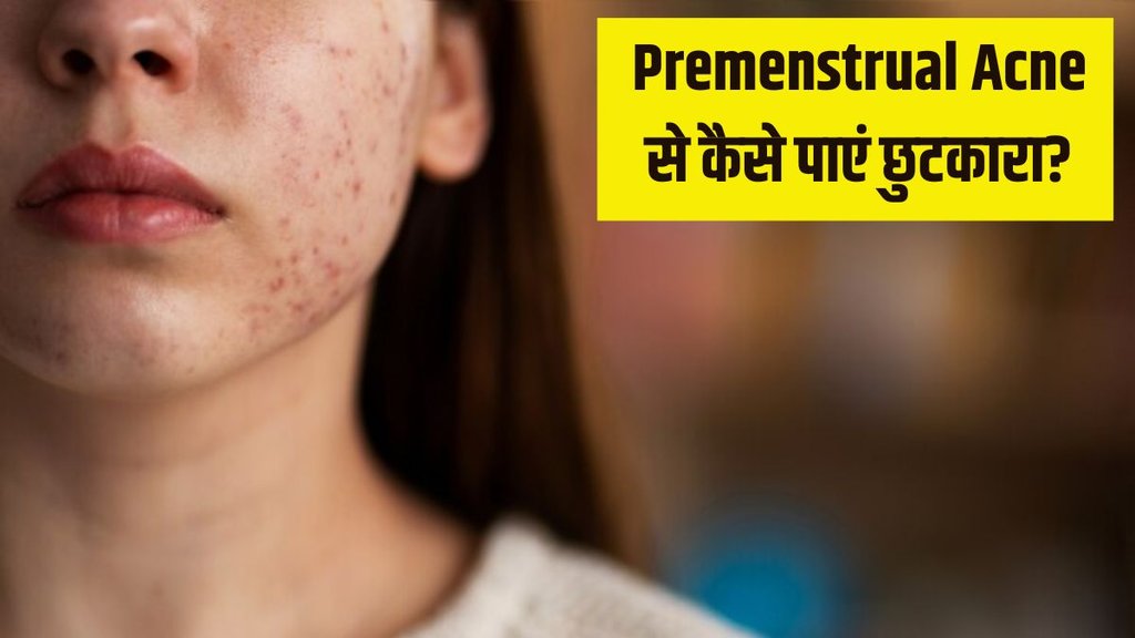 Premenstrual Acne । Premenstrual Acne Tips । Period Acne । Period Acne Tips