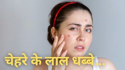 Red Spots On Skin: सर्दी में भी चेहरे पर नहीं होंगे लाल धब्बे, ये घरेलू उपाय आएंगे काम