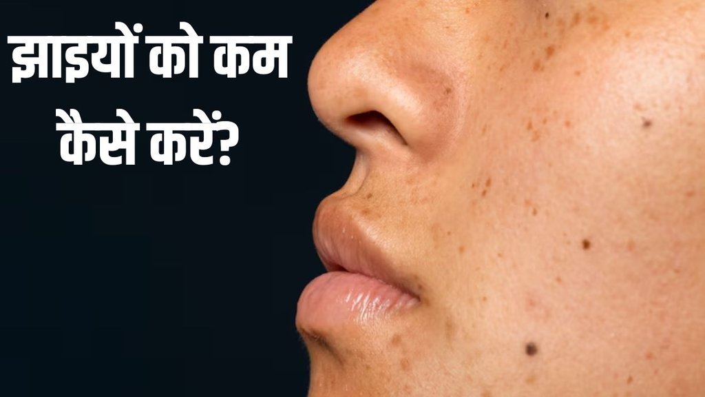 Skin pigmentation । Melasma । Skin Care