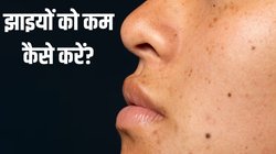 चेहरे से काली झाइयां कैसे साफ करें? स्किन के डॉक्टर ने बताई 3 आसान टिप्स