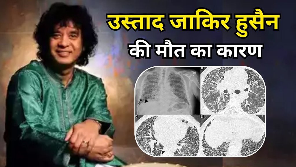 Zakir Hussain Death Reason: इडियोपैथिक पल्मोनरी फाइब्रोसिस बीमारी के कारण हुई उस्ताद जाकिर हुसैन की मौत