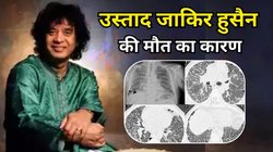तबला वादक उस्ताद Zakir Hussain का निधन, इडियोपैथिक पल्मोनरी फाइब्रोसिस की वजह से हुई मौत, जानिए A TO Z इस बीमारी की जानकारी