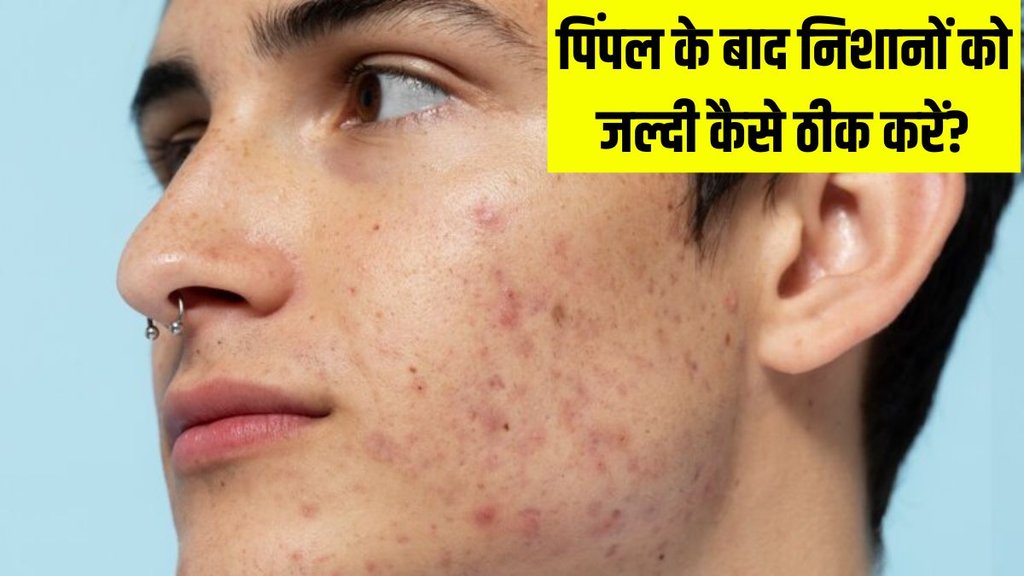 Acne Marks । how to remove acne marks । beauty Tips