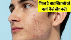 Acne-Pimple के बाद चेहरे पर निशान क्यों हो जाते हैं? एक्सपर्ट्स से जानें इनसे जल्दी छुटकारा पाने के उपाय