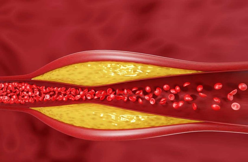 bad cholesterol